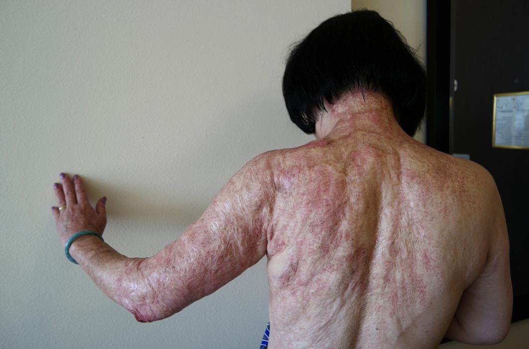 Nick Ut | I samband med att laserbehandlingen av Kim Phuc inleddes i september 2015 fotograferades hon återigen av mannen som tog den ikoniska bilden 1972, AP-fotografen Nick Ut.
