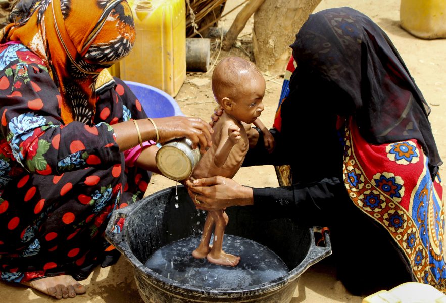 Hammadi Issa/AP/TT | Här badas ett undernärt barn i jemenitiska staden Aslam.