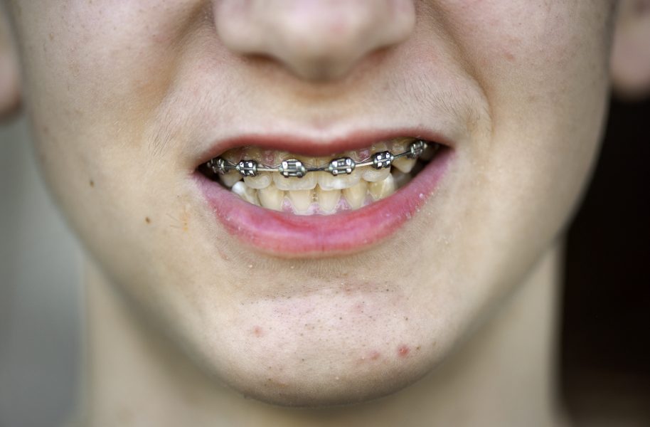 Anders Wiklund/TT | Nästan var tredje stockholmare i åldern 15–17 år har frätskador på tänderna.