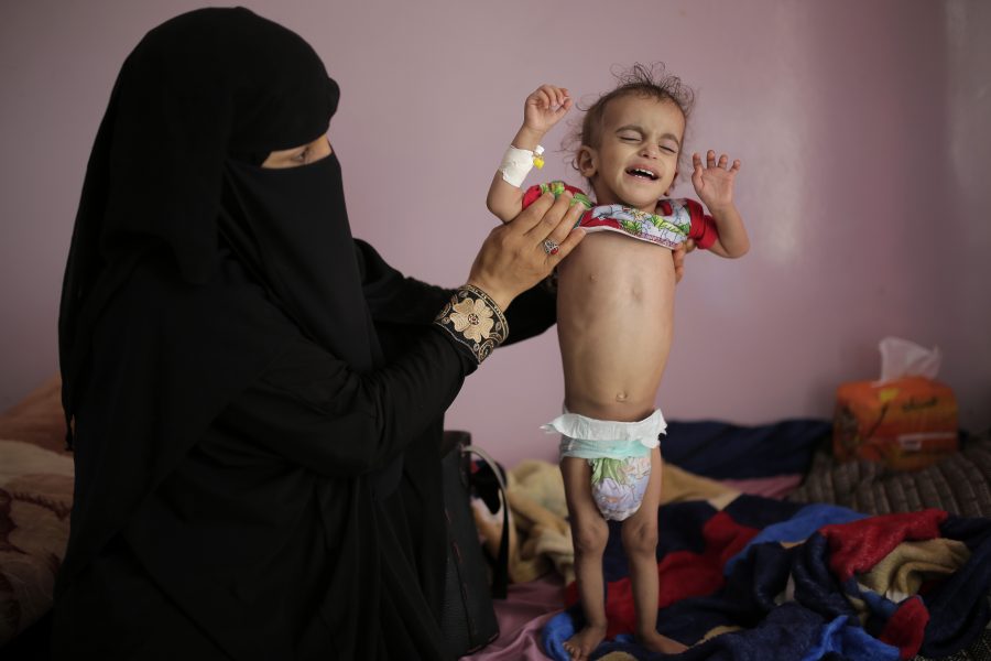 En mamma med sitt undernärda barn på ett sjukhus i Sana, Jemens huvudstad, Decennier av krig har lett till att många jemeniter växer upp med åtminstone perioder av svält.