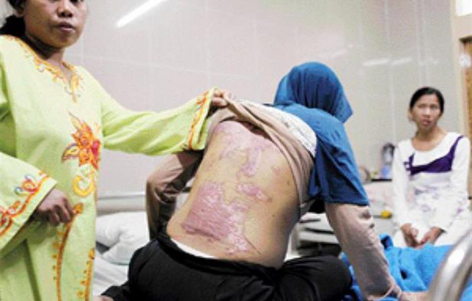 Indonesisk migrantarbetare misshandlad i Saudiarabien.