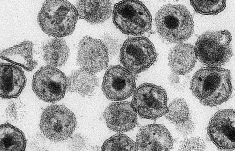 Forskning pågår för att stoppa hiv-infektion, bland annat genom arbete med blodceller, som på denna mikroskopbild tillhandahållen av CDC (Centers for Disease Control).