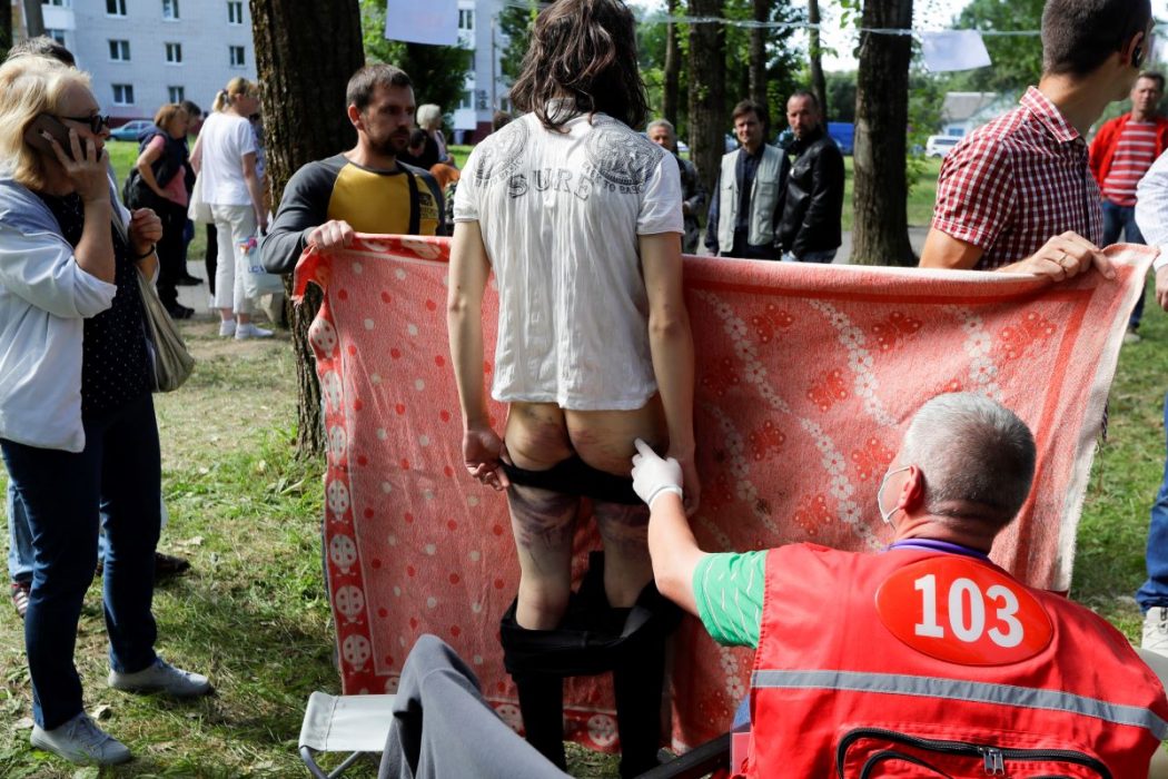 En man visar blåmärken efter polisens slag i ett förvar av gripna demonstranter.