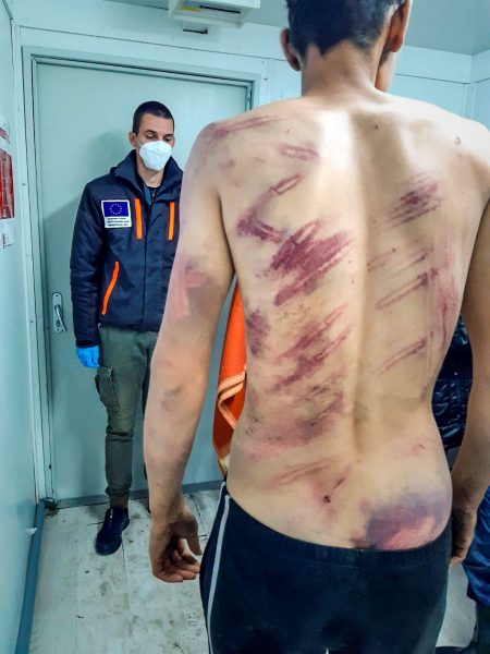 Foto taget av sjukvårdspersonal i Bosnien som dokumenterat skadorna hos en man som blivit misshandlad när han försökt ta sig över den kroatiska gränsen.