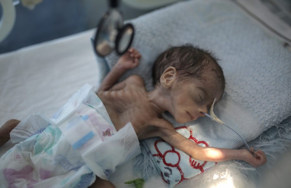 Ett av fem barn i Jemen är svårt undernärda.