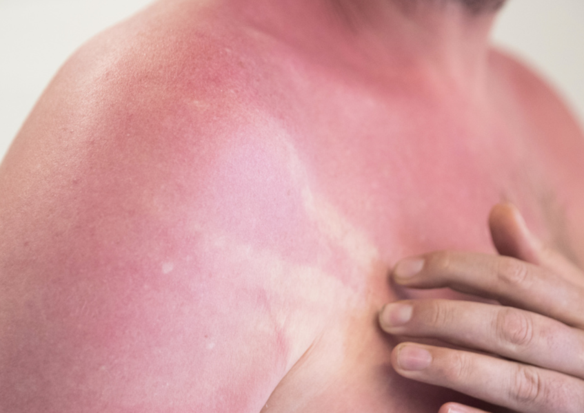 Du behöver inte ens bli bränd för att solen ska vara skadlig och kunna ge upphov till hudcancer.