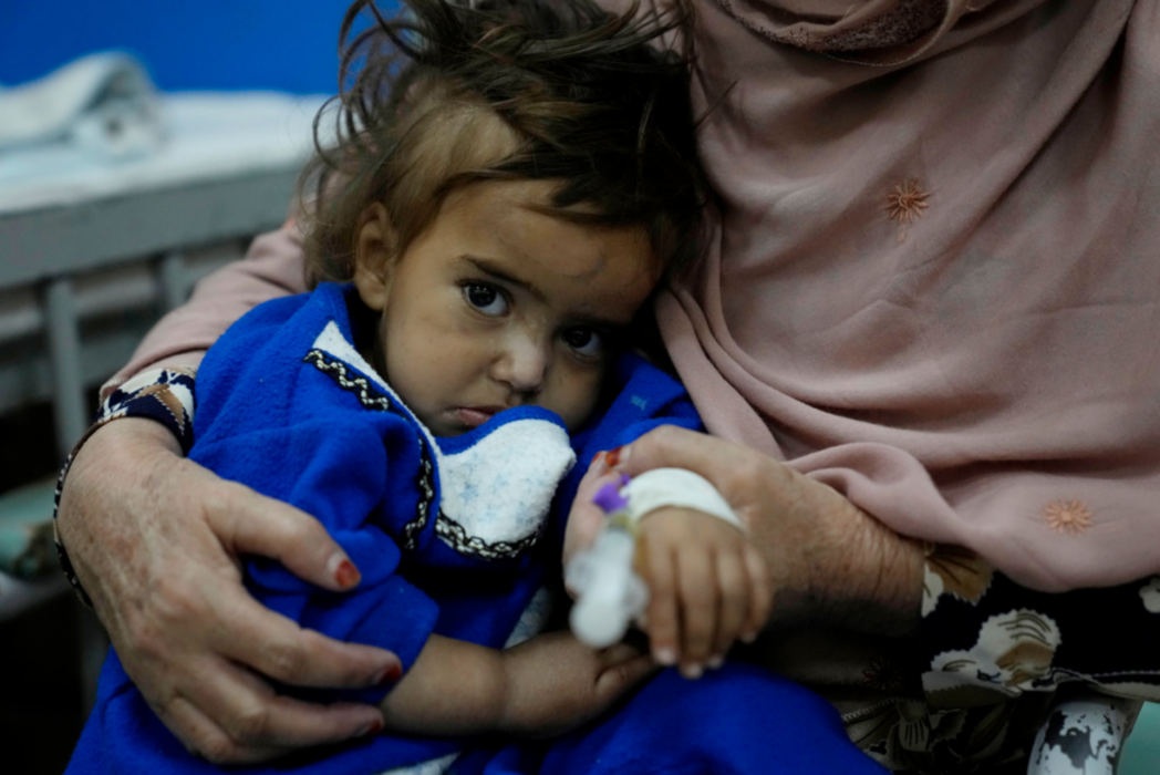En afghansk flicka vårdas för undernäring på ett sjukhus i Afghanistans huvudstad Kabul.