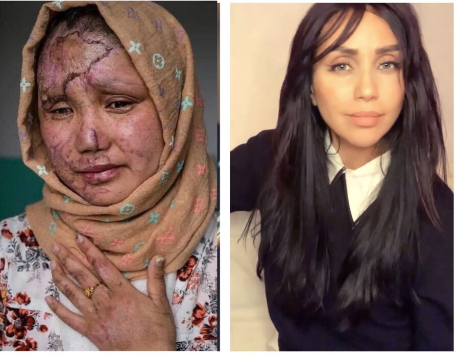 Det här fotot berättar en enkel historia om en flicka som studerade på universitetet i västra om Kabul där hennes vänner och klasskamrater sprängdes i bitar under självmordsattacken i fredags, men hon överlevde med sina skador för livet, skriver debattören.