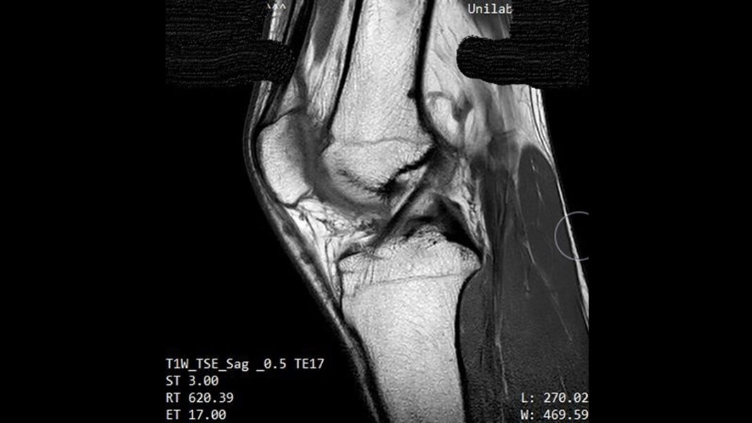 Magnetröntgenbild av knäled.
