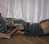 En utmärglad pojke vars revben och ryggkotor tydligt syns ligger på en sjukhussäng.